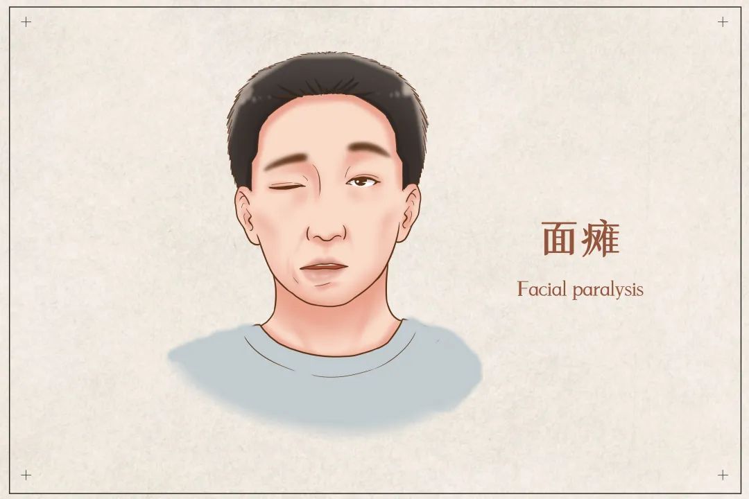 面瘫的中医科普