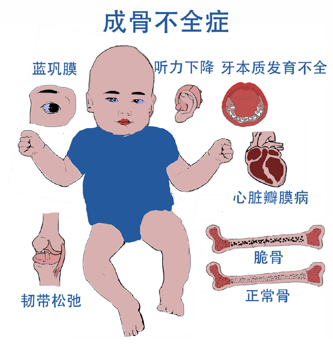 脆弱的小天使：解密儿童成骨不全症