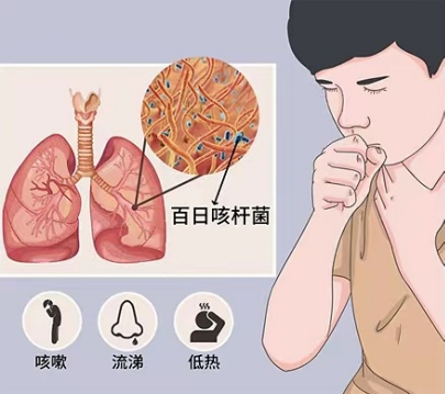 宝宝咳到停不下来？要小心百日咳偷袭
