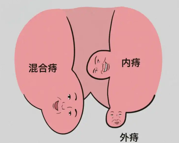混合痔：肛肠科的“常见烦恼”，科学应对有妙招