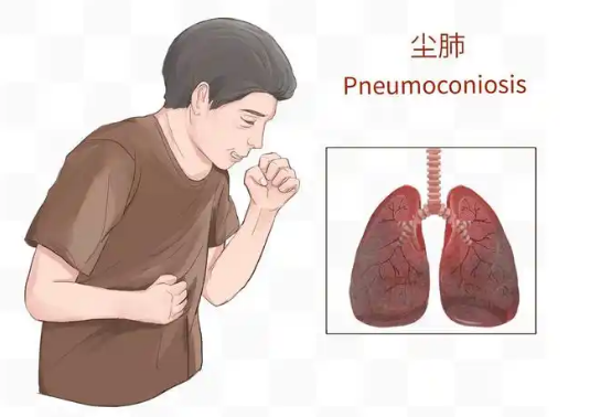 警惕沉默的杀手----职业性尘肺病
