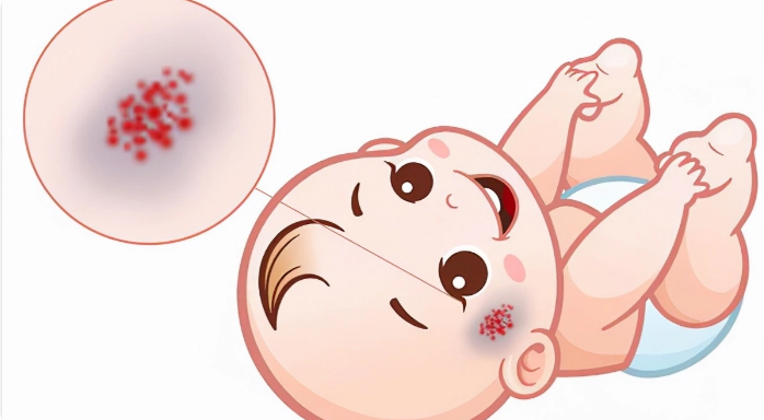 婴幼儿血管瘤：红疹背后的秘密