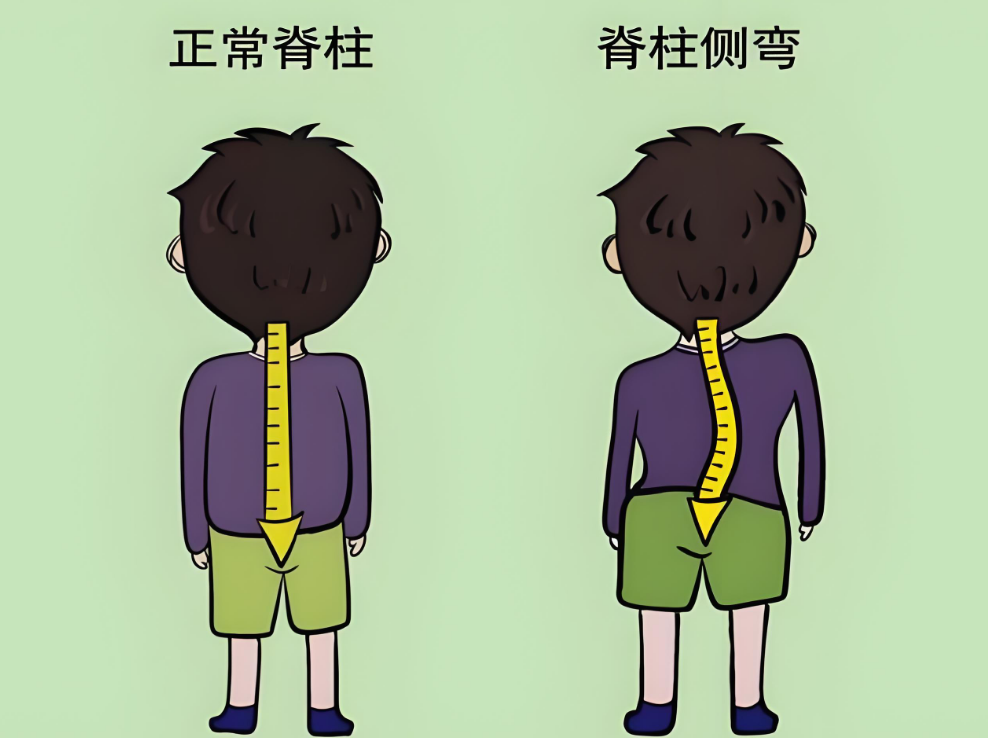 挺直未来—关爱儿童青少年脊柱侧弯