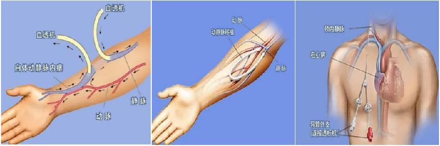 他们为透析患者带回“国家级”血管通路技术