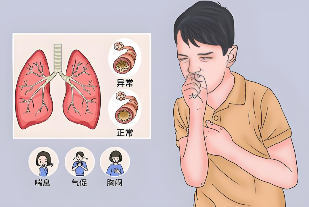 哮喘防治全攻略