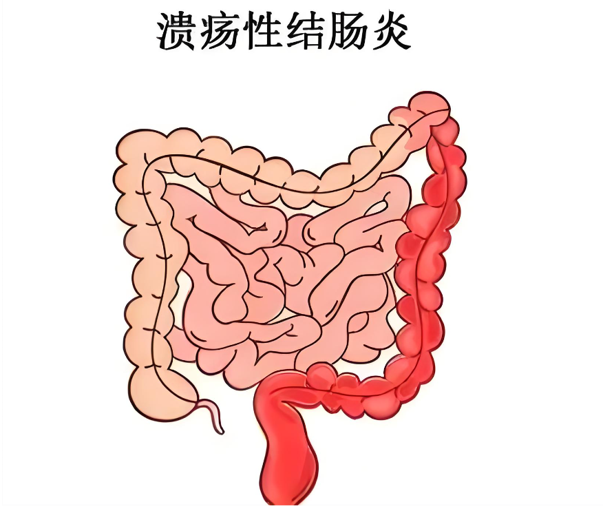 溃疡性结肠炎