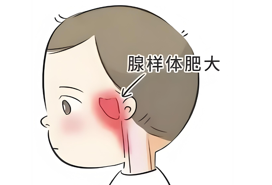 当心过敏性鼻炎和腺样体肥大