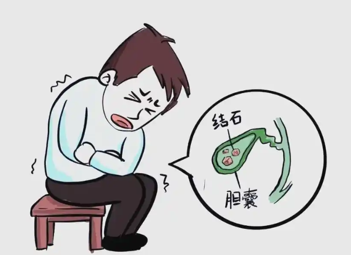 胆总管结石与ERCP治疗